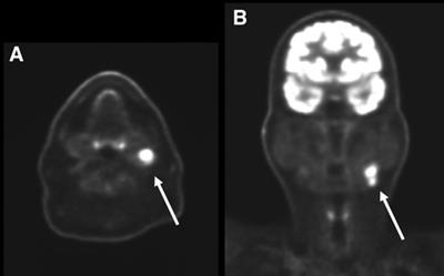 Diagnostic accuracy of latest generation digital PET/CT scanner for detection of metastatic lymph nodes in head and neck cancer